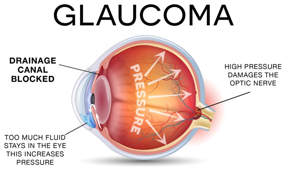 Intraocular Pressure - All About Vision